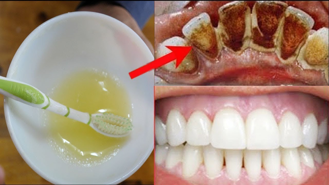 انقذ اسنانك من التسوس.. مكون رهيب لتبيض الأسنان كالؤلؤ في 3 دقائق وإزالة الجير والأصفرار أقوي من الليزر