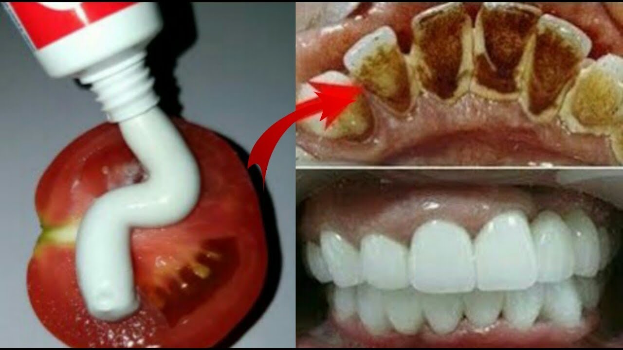 صدق أو لا تصدق تبييض الأسنان في 3 دقائق وإزالة الاصفرار والجير المتراكم بمكون سحري في مطبخك
