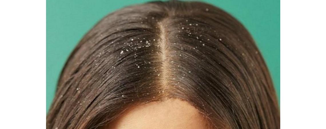 التخلص من قشرة الشعر بطرق طبيعية