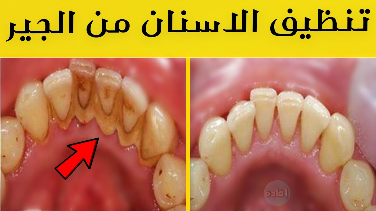 تنظيف الاسنان من الجير