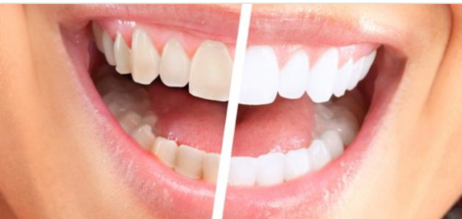 كيفية تنظيف أسنانك من الجير بطرق طبيعية وجديدة فعالة 100%