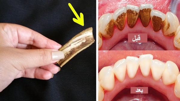 طريقة اخفوها عنك الأطباء سنوات لتبيض الأسنان كالؤلؤ وإزالة الجير والأصفرار والرائحة الكريهة في 3 دقائق