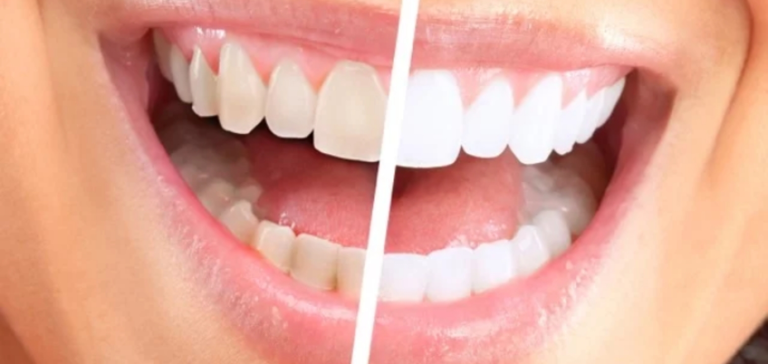 طريقة تبييض الأسنان في يوم واحد بأسرار طبيعية 100% من البيت