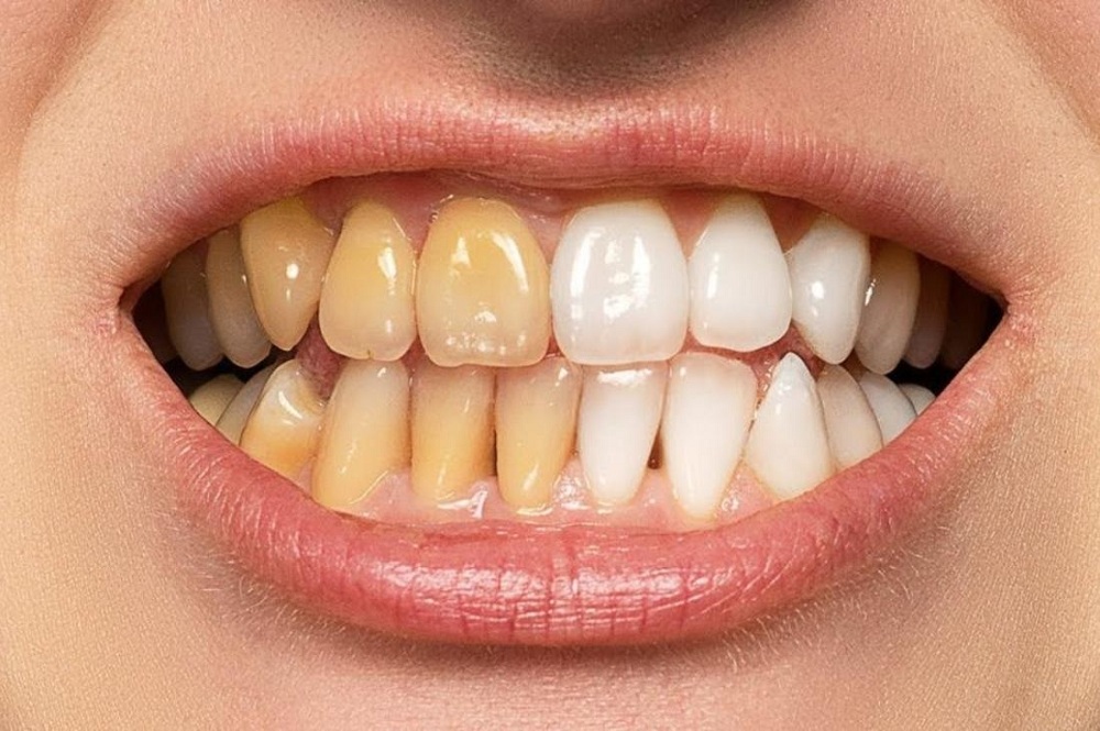 طرق منزلية سريعة للتخلص من الأسنان الصفراء طبيعية وآمنة