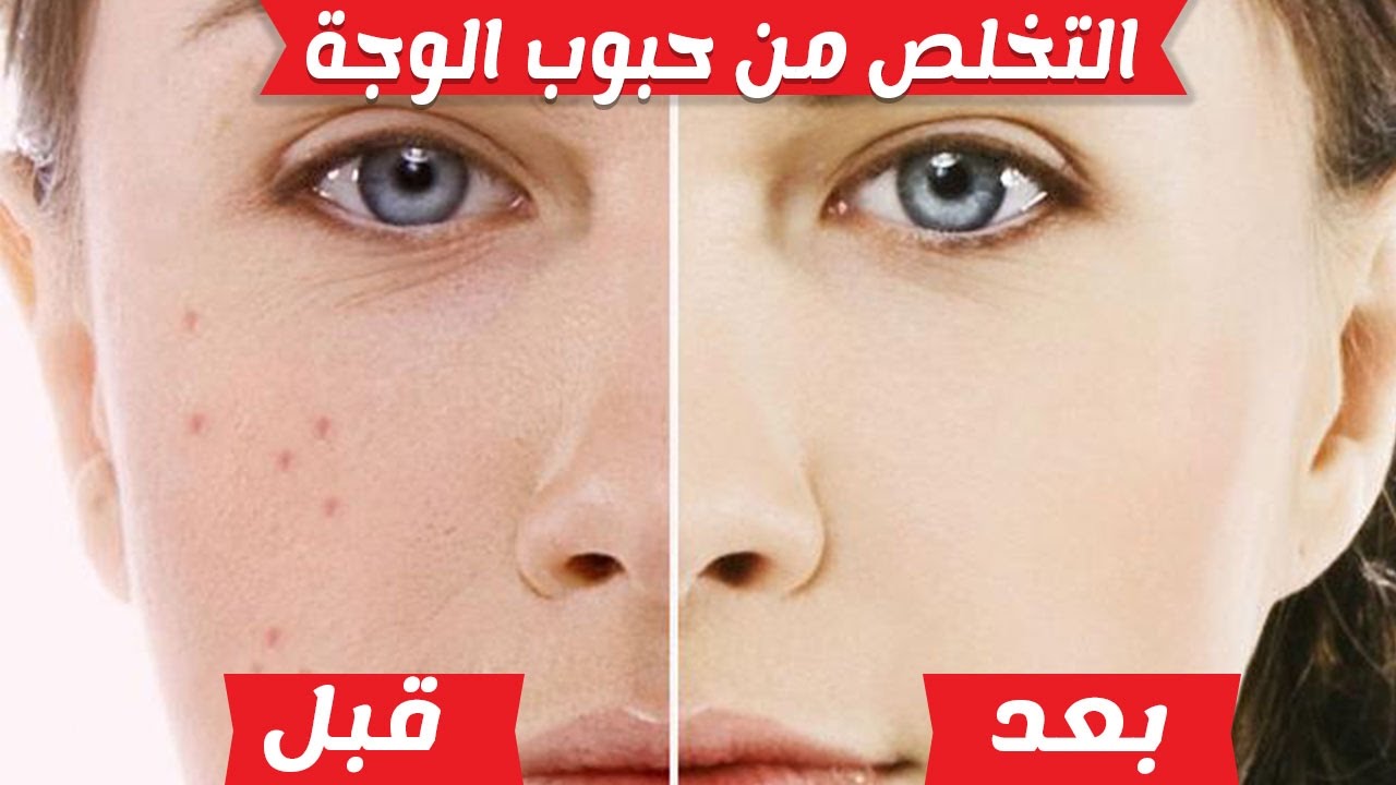 طرق التخلص من حبوب الوجه