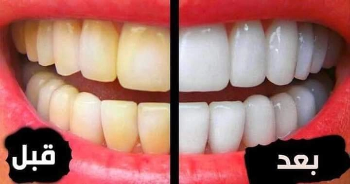 أسنان كالؤلؤ..وصفه جبارة لتبيض الأسنان والتخلص من خير الأسنان المتراكم والتخلص من الاصفرار