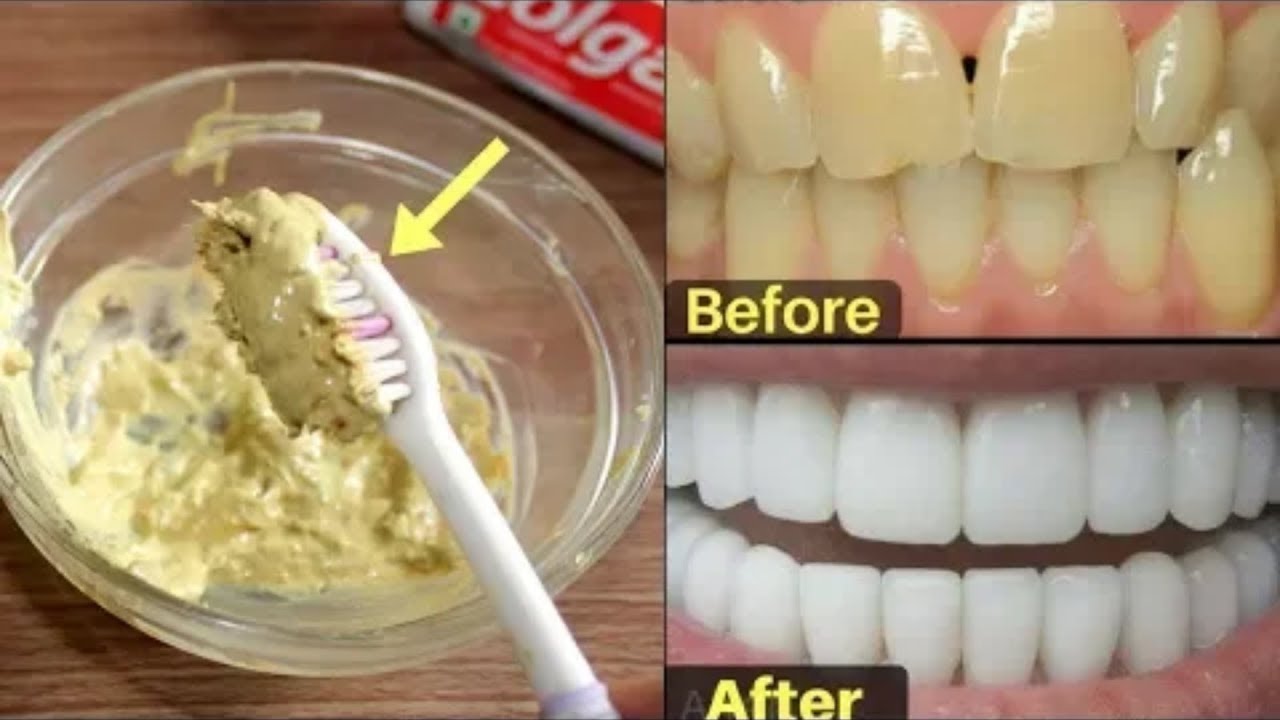 احصل على أسنان بيضاء في دقيقتين فقط كيفية تبييض الأسنان في دقيقتين