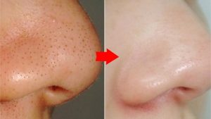 كيفية إزالة الرؤوس البيضاء من الوجه بشكل طبيعي