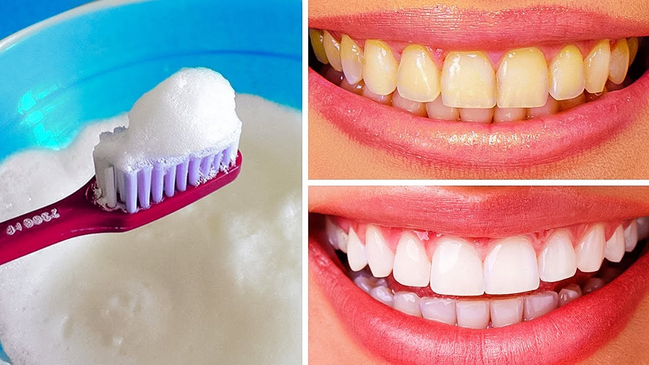 آمنة على اللثة.. تبييض الأسنان بسرعة في المنزل بمكون ترميه كل يوم سينقذ أسنانك من الضياع والاصفرار