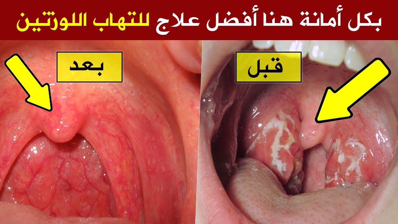 طرق علاج الحلق واللوزتين