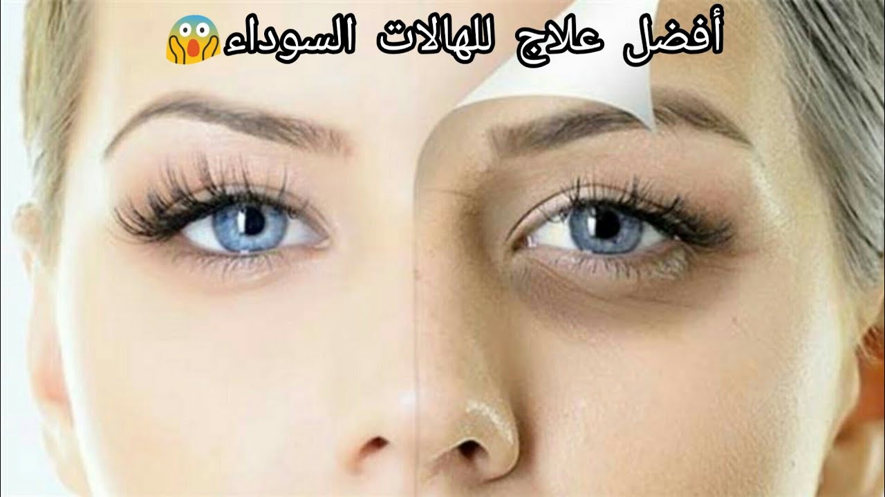 كيفية إزالة الهالات السوداء تحت العين بأسرع وقت