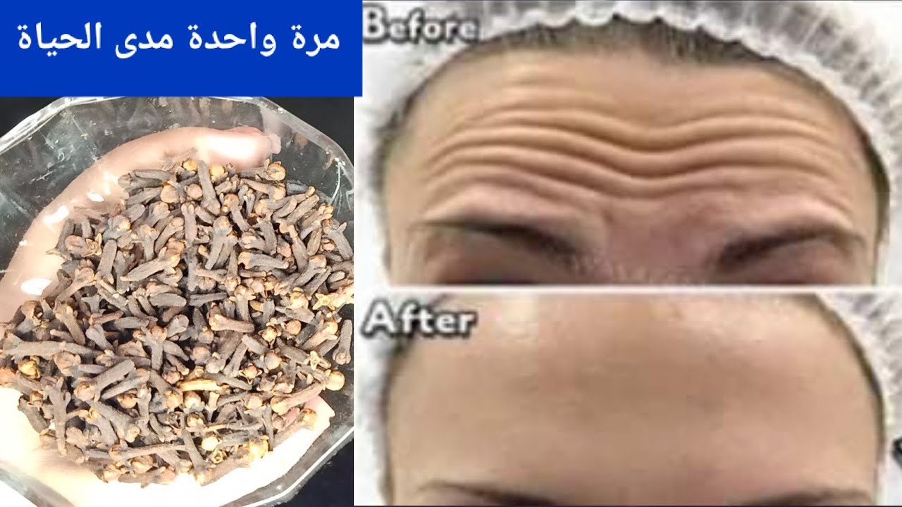 القرنفل لتبيض الوجه