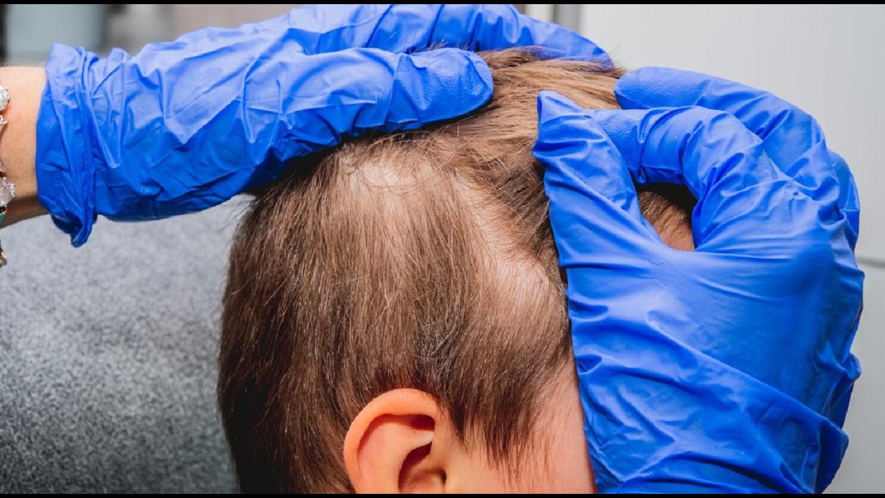 علاج تساقط الشعر عند الأطفال
