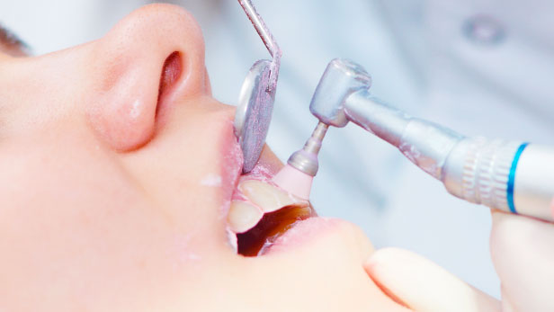 متى يصبح تلميع الأسنان مضر؟