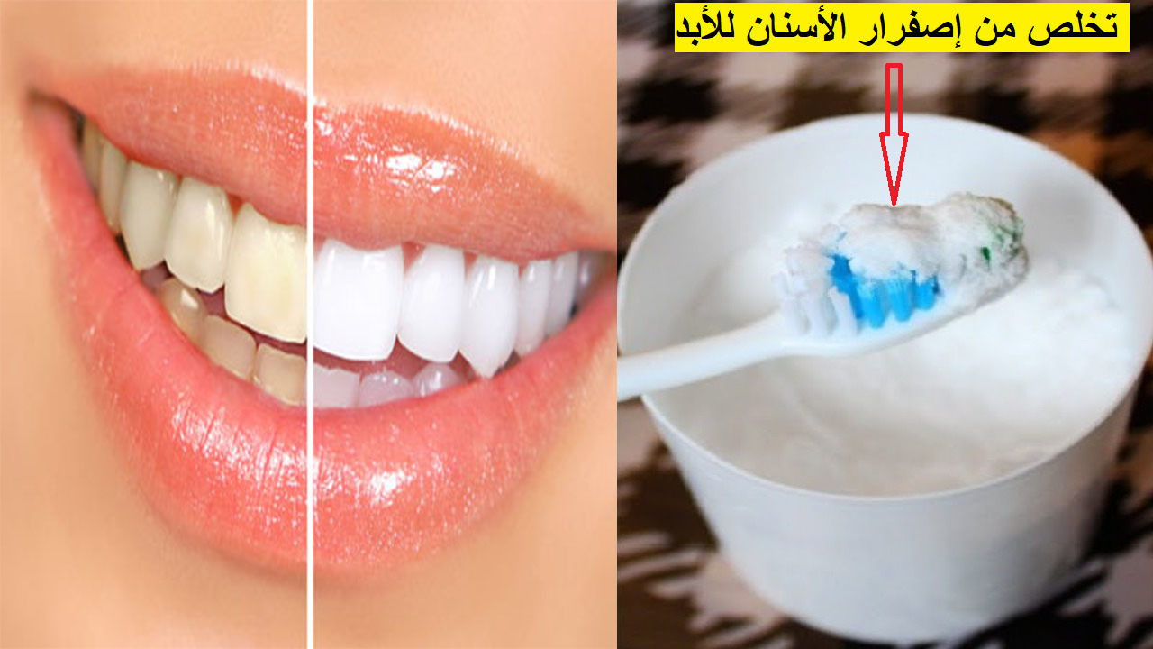 yellowing teeth treatment