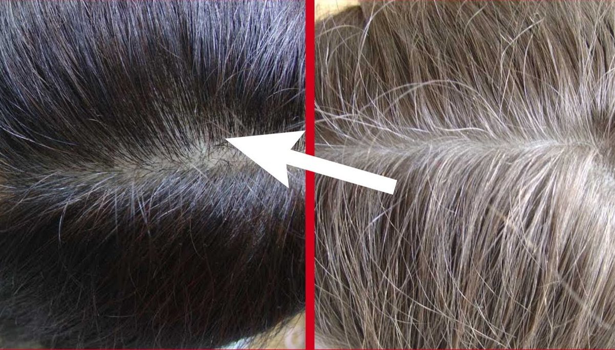 ودعي شيب الشعر ... وصفات طبيعية للتخلص من الشعر الأبيض وبدون صبغات والنتيجة مضمونة100%