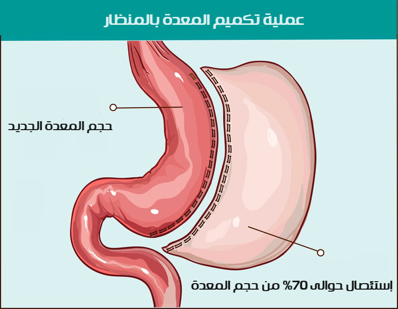 تكميم المعدة بالمنظار