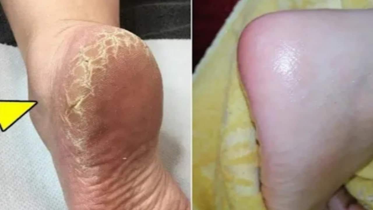 اقوي مقشر لتنعيم وتوريد الكعبين وإزالة الجلد الميت والتشققات من أول يوم هتبقي قمر 14