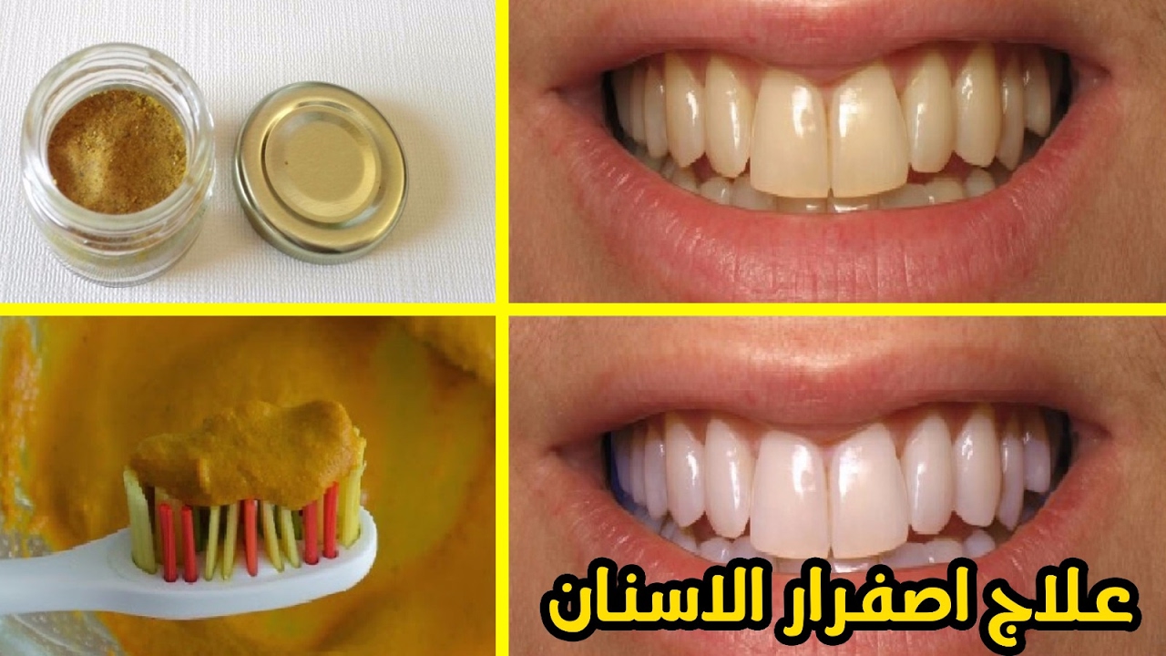 التخلص من اصفرار الأسنان