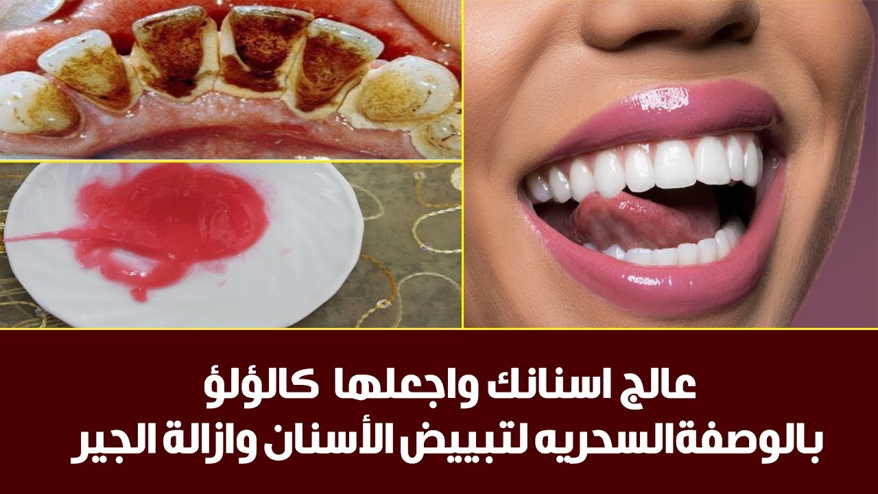 وصفات تبييض الأسنان