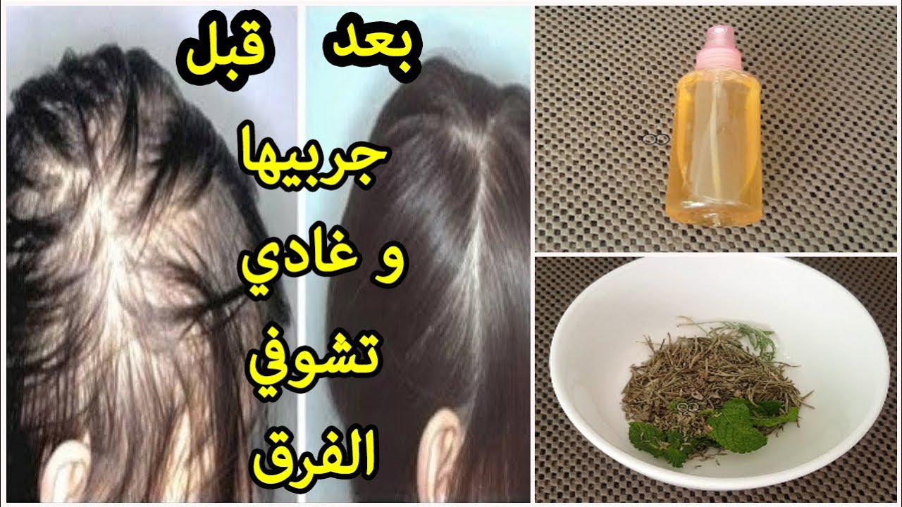 السر الياباني لعلاج الصلع… وصفة تسريع نمو الشعر وملء الفراغات في اسبوع واحد نتيجة جبارة