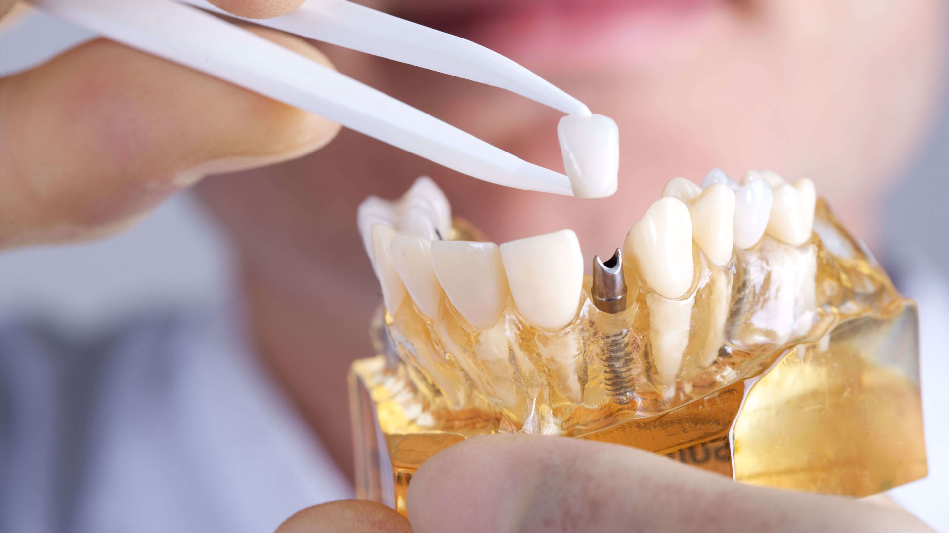هل زراعة الأسنان مؤلمة ؟.. وما هي أسعار زراعة الأسنان في السعودية 2023
