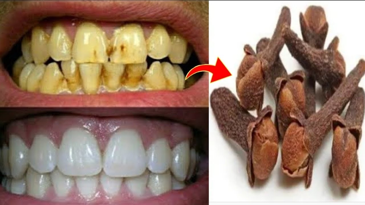 انقذ اسنانك.. القرنفل لتبييض الأسنان الصفراء وازالة الكلس والروائح الكريهه والاصفرار في دقائق