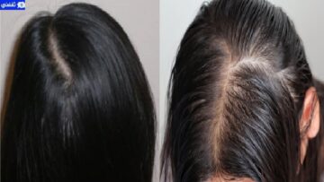 أقوى وصفة لانبات الشعر وملء الفراغات والعلاج الأمثل لتساقط الشعر