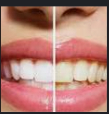 تبييض الاسنان وإزالة الجير بمكونات بسيطة تجعل اسنانك بيضاء من اول استخدام