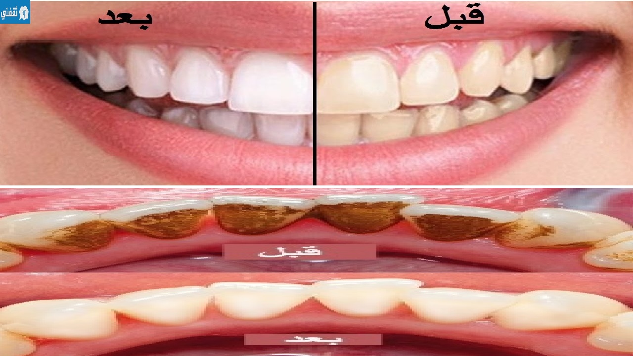 وصفة طبيعية سحرية لتبييض الأسنان