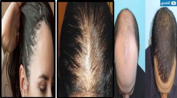 علاج تساقط الشعر بالزيوت الطبيعية والنتيجة خلال أيام