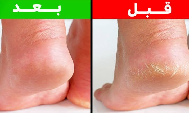 وصفة طبيعية لعلاج تشقق القدمين واليدين بالفازلين