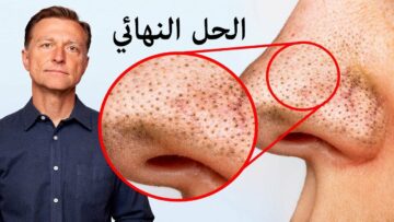 طرق التخلص من الرؤوس السوداء والحصول على بشرة صافية ونضرة بسهولة بدون مكياج