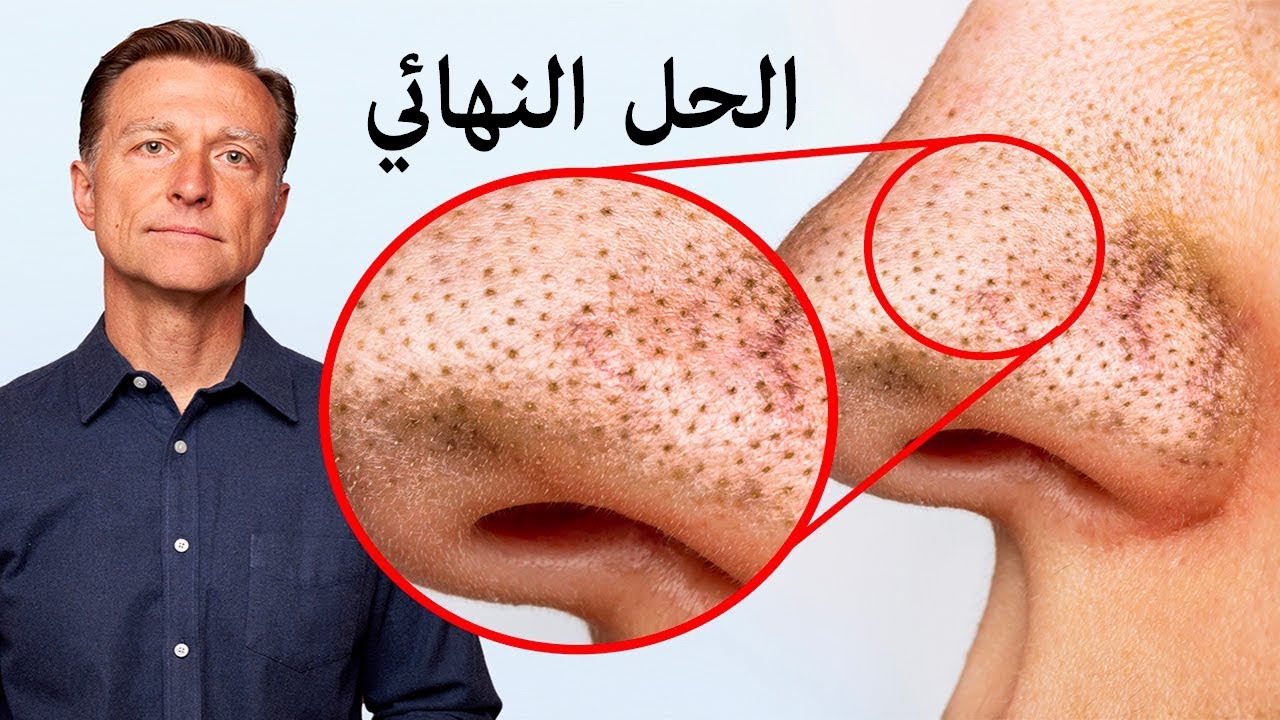 طرق التخلص من الرؤوس السوداء