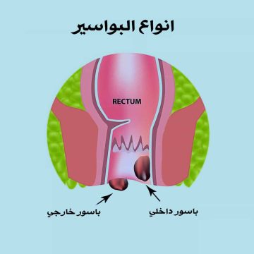 طريقة علاج البواسير بالصبار بدون عملية جراحية