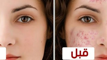 وصفة طبيعية للتخلص من حبوب الوجه بشكل نهائي وجعلها صافية ونقية
