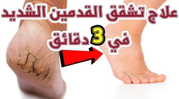 علاج تشقق القدمين