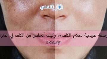 وصفة طبيعية لعلاج الكلف