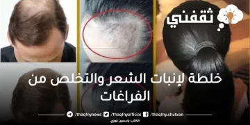 افضل خلطة لإنبات الشعر في الفراغات وتكثيفه بفاعلية وتخلص من الاحراج