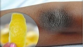 انسى سواد السنين مع الوصفة الجبارة لتبييض الكوعين والرقبة في أقل من أسبوع