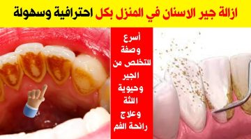 إزالة جير الأسنان بكربونات الصوديوم