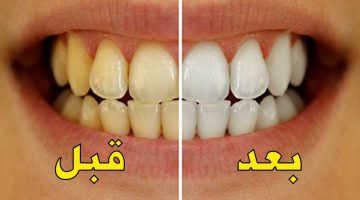 طرق تبييض الأسنان في المنزل باستخدام مكونات طبيعية كالنشا والملح