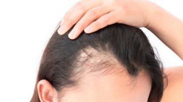 علاج الشعر المنحول من الأمام