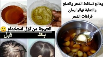 علاج تساقط الشعر بالثوم