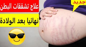 تشققات البطن بعد الولادة