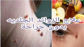 علاج الزوائد الجلدية بسرعة