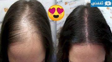 وصفات مضمونة لتقليل تساقط الشعر