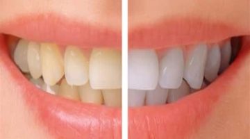 وصفات طبيعية فعالة لتبيض الأسنان