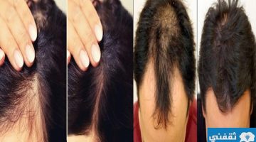 أقوى وصفة طبيعية لعلاج تساقط الشعر