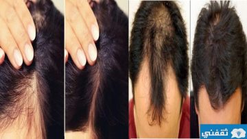 أقوى وصفة طبيعية لعلاج تساقط الشعر الشديد وتقوية بصيلات الشعر